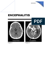 Encephalitis