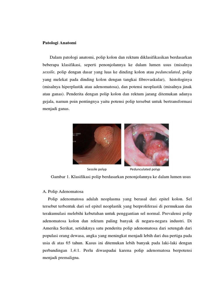 Klasifikasi Polip Rektum dan Adenomatosa | PDF | Sains & Matematika