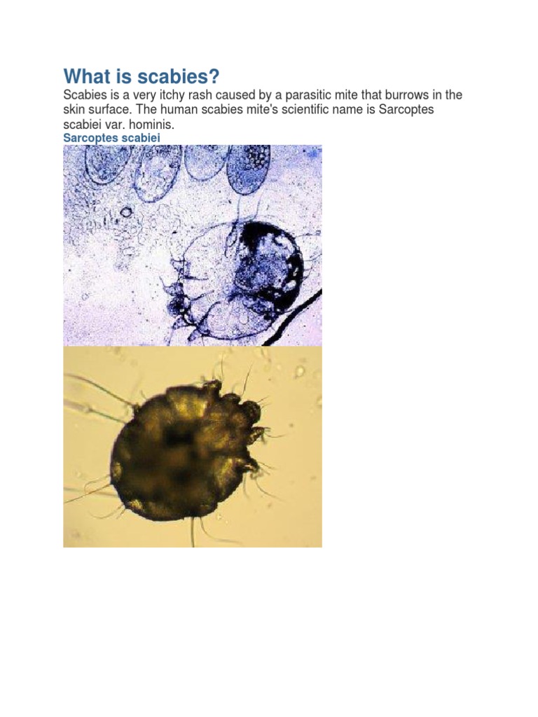 What Is Scabies? | PDF | Epidemiology | Cutaneous Conditions