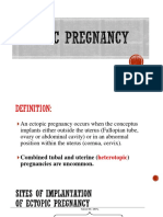Ectopic Pregnancy1