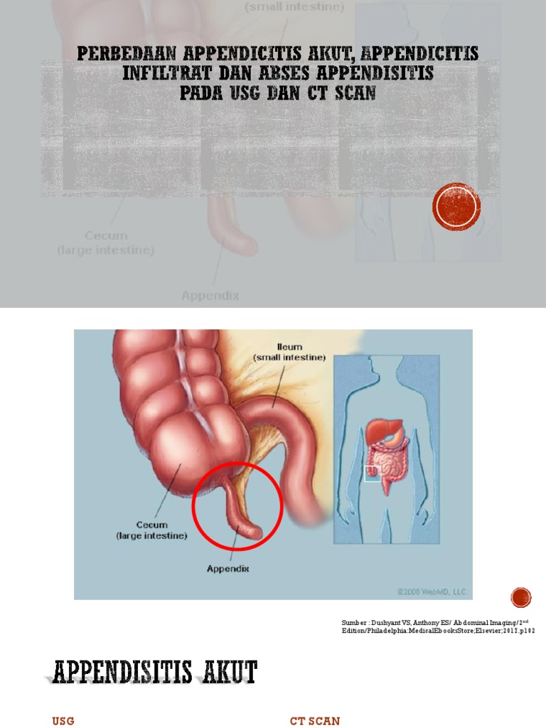 Imaging of Acute Appendicitis | PDF | Ct Scan | Medicine