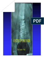 Osteoporosis: Causas, Etapas y Tratamiento