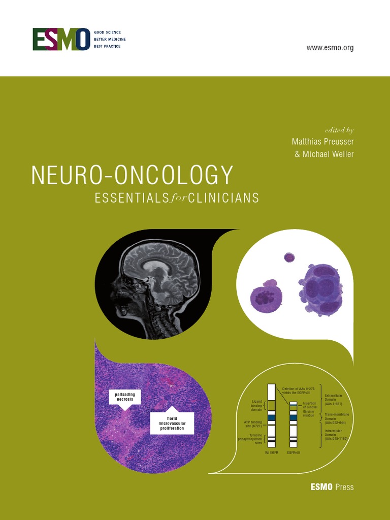 Neuro Oncology Neuro Oncology Essentials Clinicians Essentials Clinicians Glioma Brain Tumor
