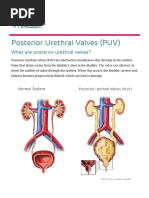 Posterior Urethral Valves (PUV) _ Children's Hospital of Philadelphia