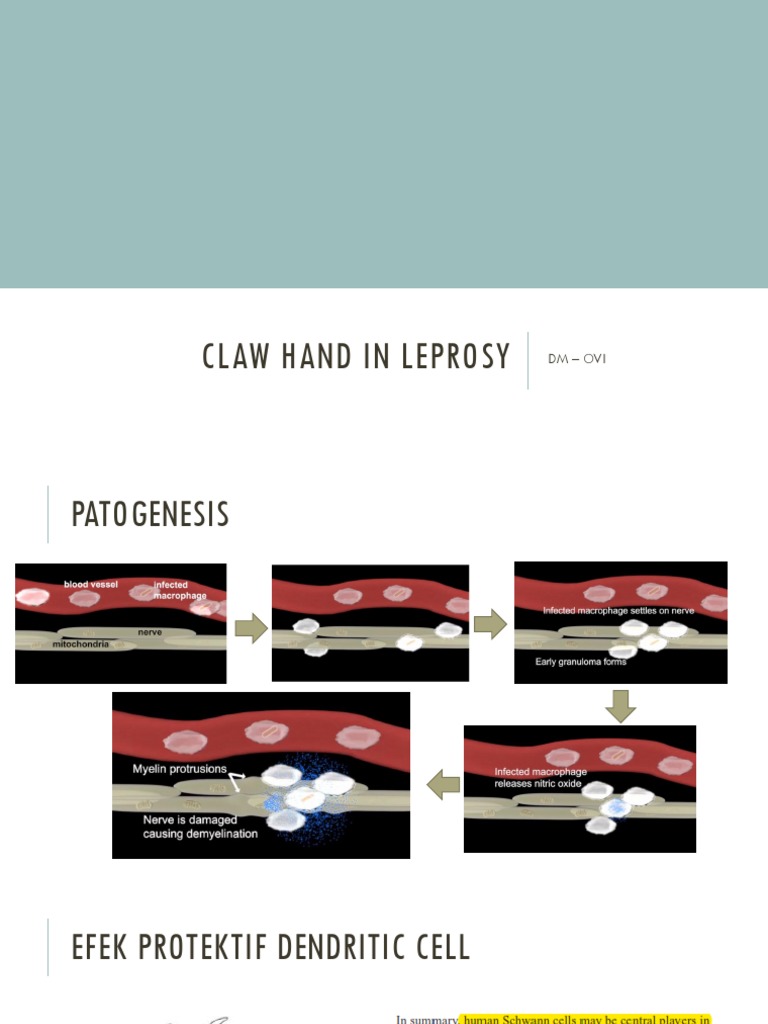 PR Claw Hand in Leprosy PDF