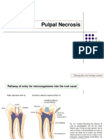 Pulpal Necrosis Causes