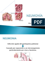 Neumonia en pediatria