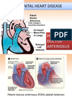 Congenital Heart Disease: Patent Ductus Arteriosus