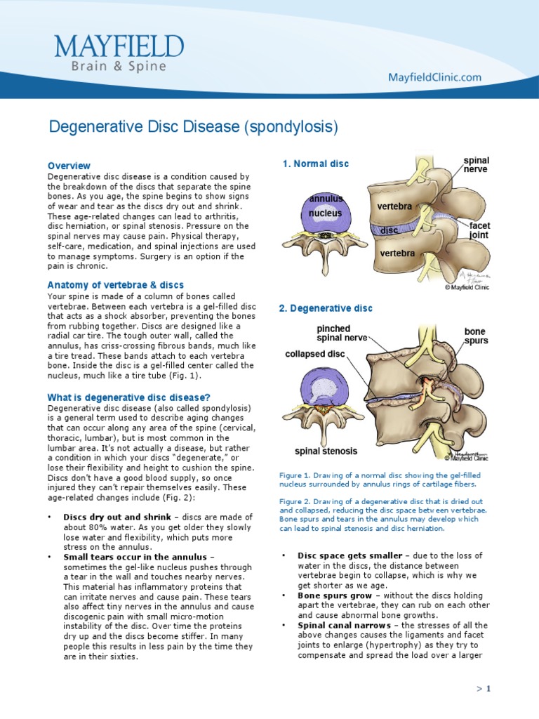 Degenerative Disc Disease (Spondylosis) | PDF | Vertebral Column | Back ...