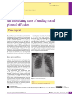 An Interesting Case of Undiagnosed Pleural Effusion