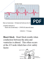 Rate in Beats/min 60/interval Between Two Beats in Seconds A Handy Shortcut Is: Heart Rate (Beats/min) 1500/R-R Interval (MM) 1500/20 75 B/min