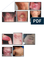 Gambar Impetigo