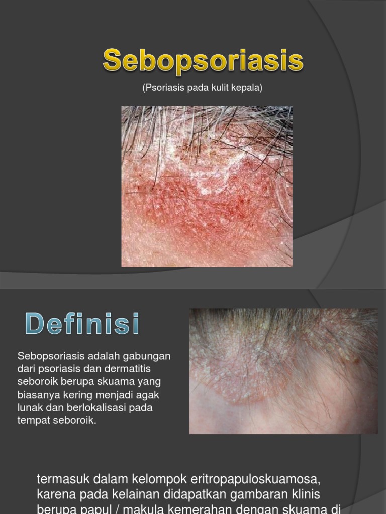 Psoriasis dan Sebopsoriasis pada Kulit Kepala | PDF | Sains & Matematika