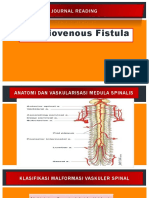 Spinal Dural Arteriovenous Fistula