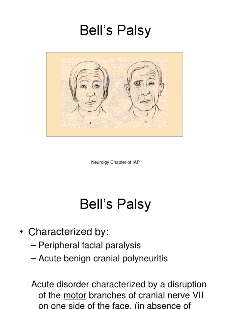 Bells Palsy PDF Diseases And Disorders Neurology