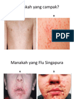 Manakah Yang Flu Singapura