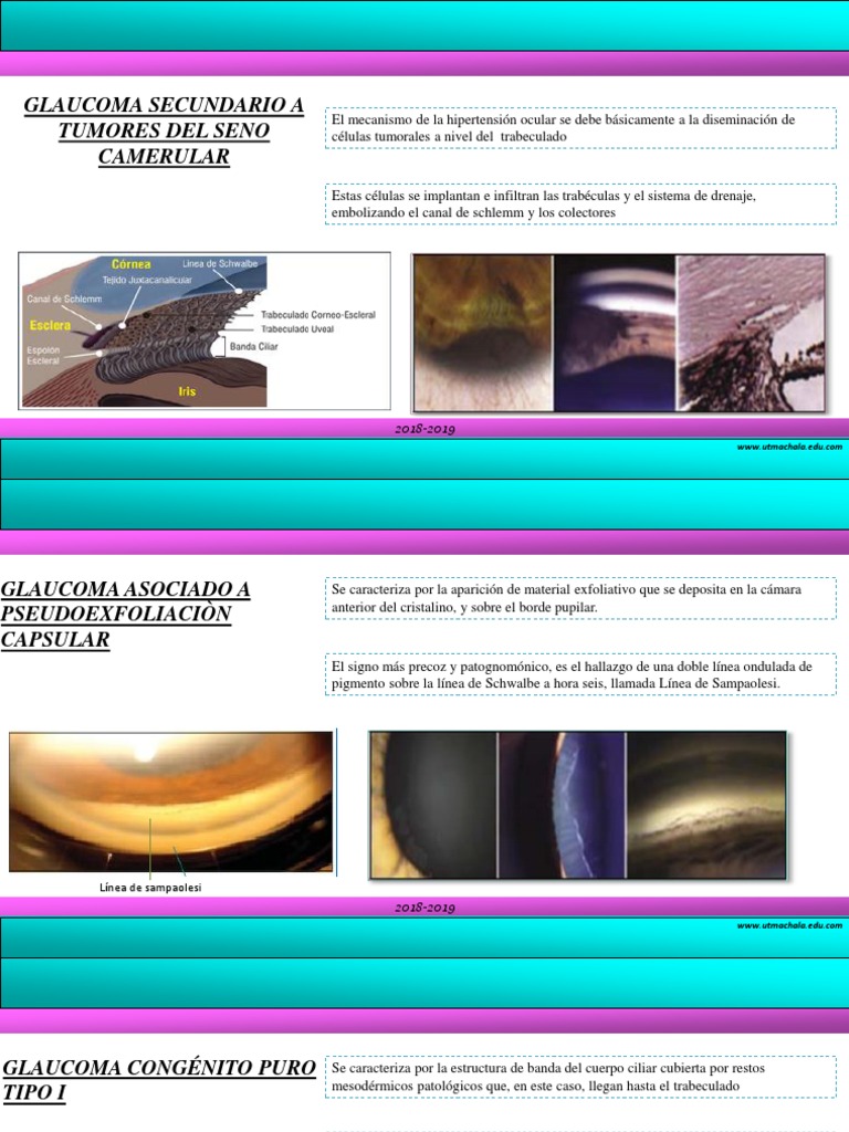 Glaucoma y Línea de Sampaolesi | PDF | Glaucoma | Percepción visual
