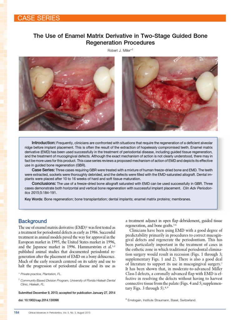 Case Series The Use of Enamel Matrix Derivative in TwoStage Guided