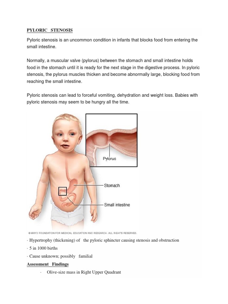 Pyloric Stenosis Olive