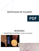 Neoplasias de Pulmon