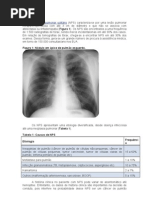 Nódulo Pulmonar Solitário