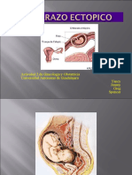 Embarazo Ectopico PDF