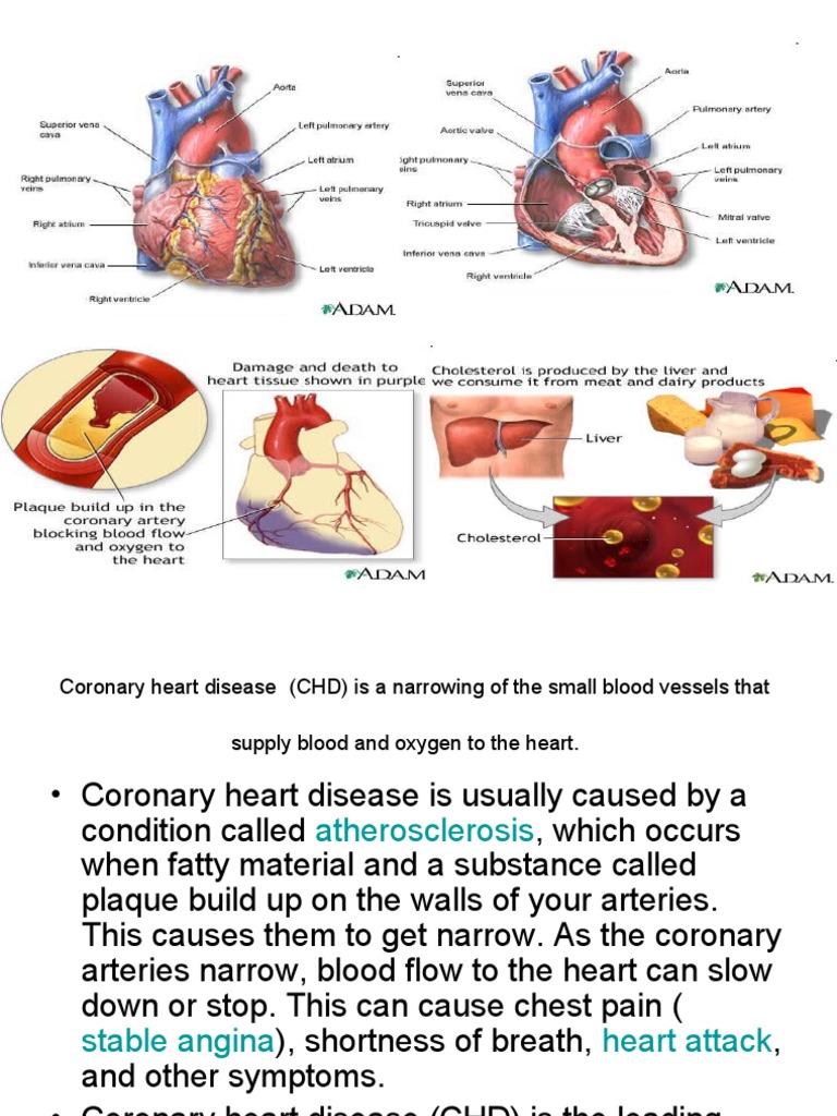 Coronary Heart Disease | PDF | Coronary Artery Disease | Atheroma