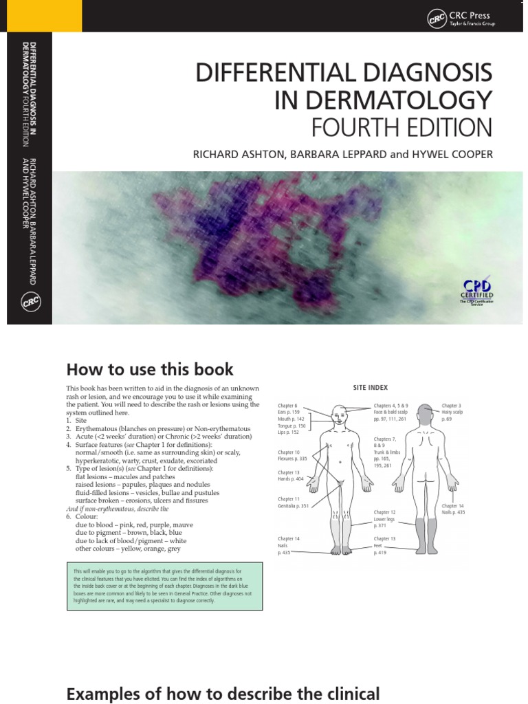 Differential Diagnosis in Dermatology Fourth Edition Richard Ashton, Barbara Leppard and Hywel