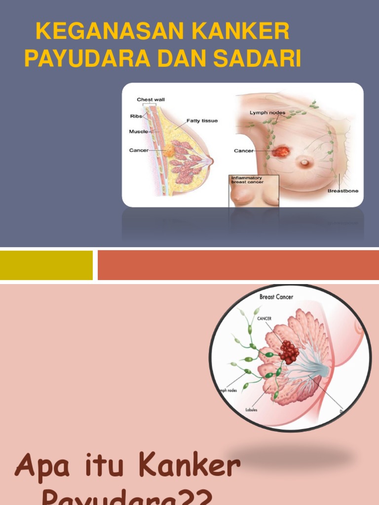 Keganasan Kanker Payudara Dan Sadari Keganasan Kanker Payudara Dan Sadari