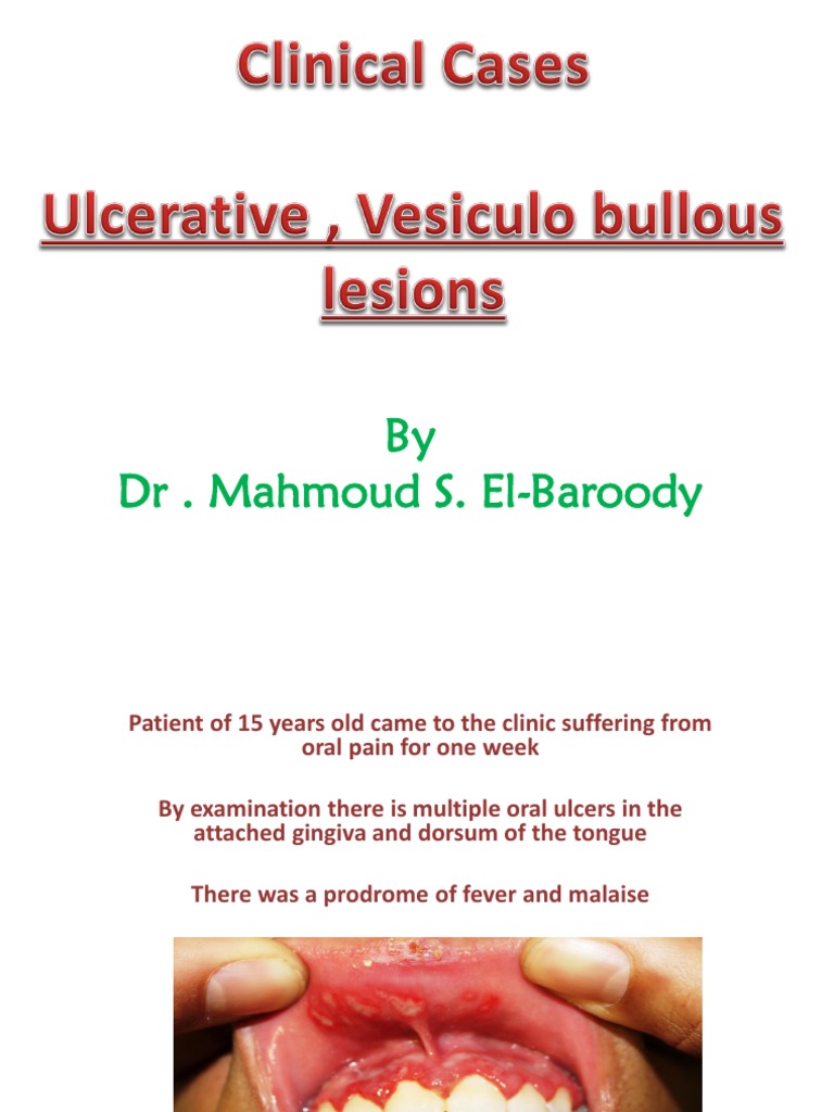 Oral Ulcers and Differential Diagnosis | PDF