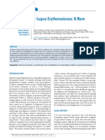 Latent Systemic Lupus Erythematosus: A Rare Case Report