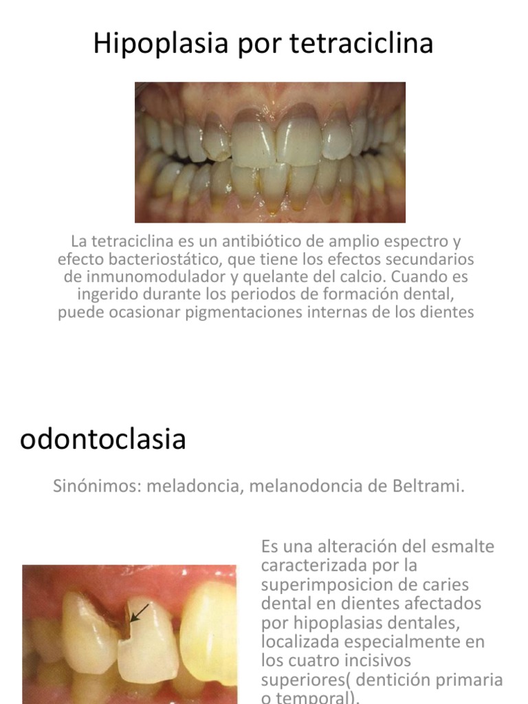 Hipoplasia Dental por Tetraciclina | PDF