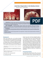 Tunnel Access For Guided Bone Regeneration in The Maxillary Anterior