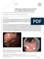 Circumferential Endoscopic Submucosal Tunnel