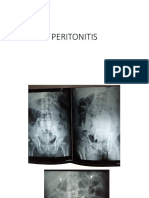 PERITONITIS - dr. Nyoman S, Sp.B.pptx