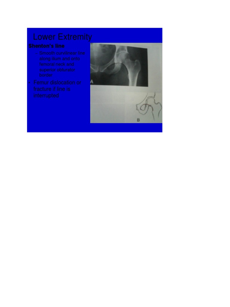 Shenton's Line and Femur Fractures | PDF