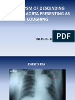 Case 2 Aneurysm of Descending Thoracic Aorta Presenting as Coughing