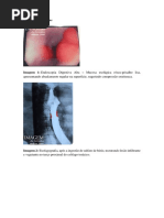 Leiomiona de esofago.pdf