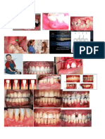 Lampiran Makalah Periodontitis