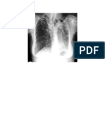 destroyed lung.docx