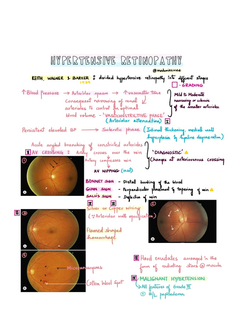 Hypertensive Retinopathy Grading Signs | PDF | Hypertension | Medicine