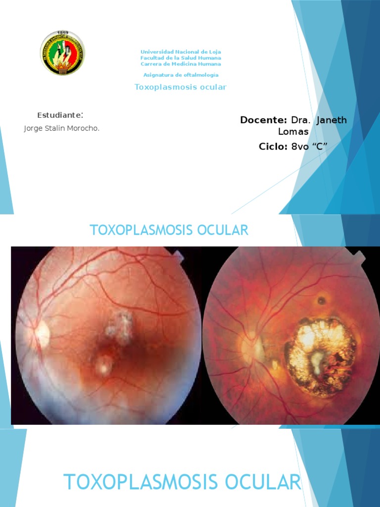 Toxoplasmosis Ocular Especialidades Medicas Enfermedades y