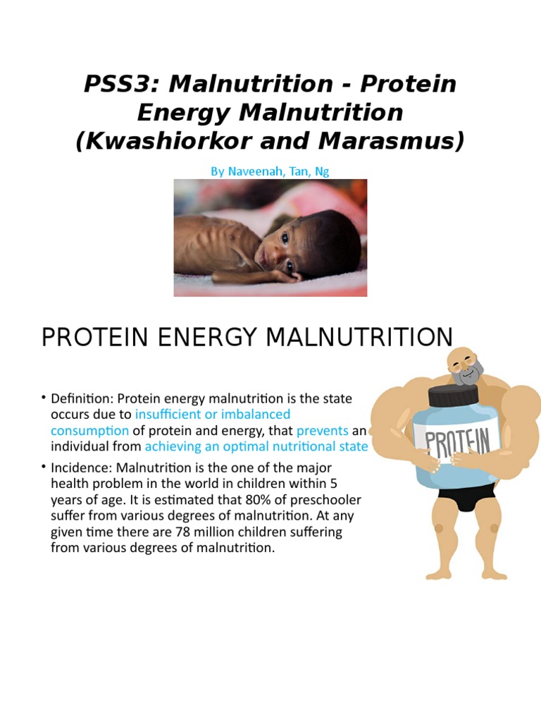 PSS3 Malnutrition Protein Energy Malnutrition (Kwashiorkor and