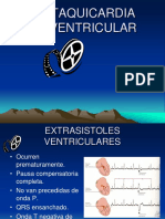 Taquicardia ventricular 