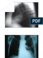 Abceso Pulmonar