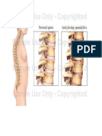 Arthritis Arthritis