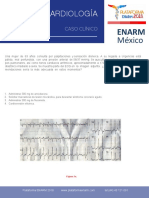 Fibrilación auricular con insuficiencia cardíaca