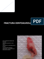 Fractura Dentoalveolar