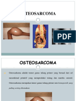 11 Osteosarcoma