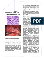 Tumor Carcinoide y Su Diseminacion